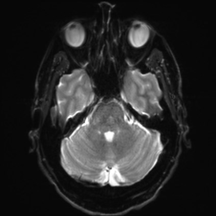 File:Amyotrophic lateral sclerosis (Radiopaedia 87352-103658 Axial DWI 7).jpg