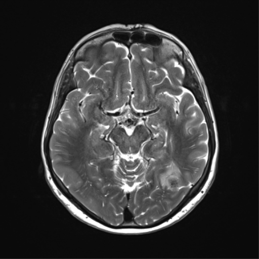 File:Anaplastic astrocytoma (Radiopaedia 86943-103160 Axial T2 17).png