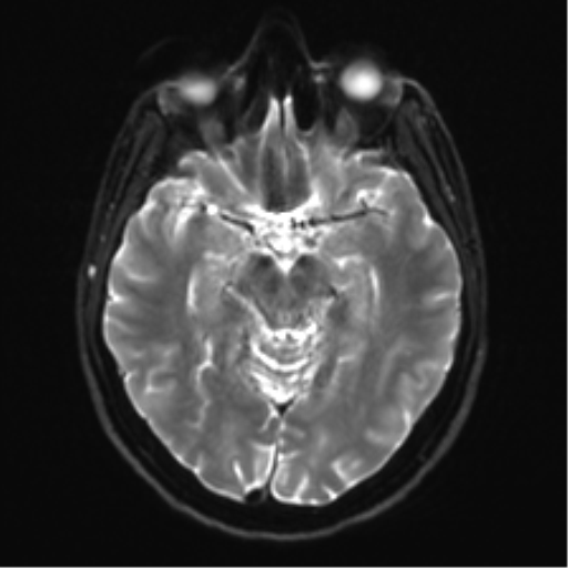 Anaplastic astrocytoma - thalamic glioma (Radiopaedia 59709-67115 Axial DWI 14).png