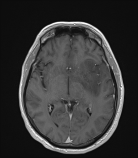 File:Anaplastic astrocytoma IDH wild-type (Radiopaedia 49984-55273 Axial T1 C+ 28).png