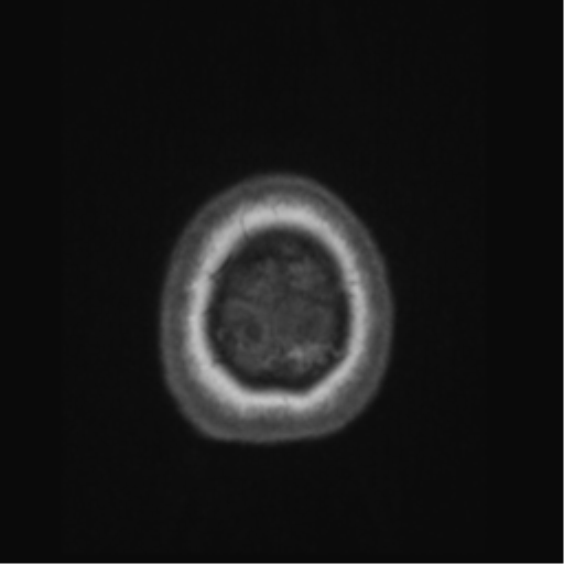 File:Anaplastic astrocytoma IDH wild-type (pseudoprogression) (Radiopaedia 42209-45276 Axial T1 146).png