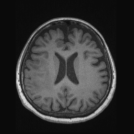 File:Anaplastic astrocytoma IDH wild-type (pseudoprogression) (Radiopaedia 42209-45276 Axial T1 95).png