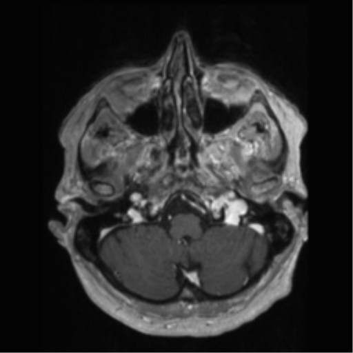 File:Anaplastic astrocytoma IDH wild-type (pseudoprogression) (Radiopaedia 42209-45277 Axial T1 C+ 17).png