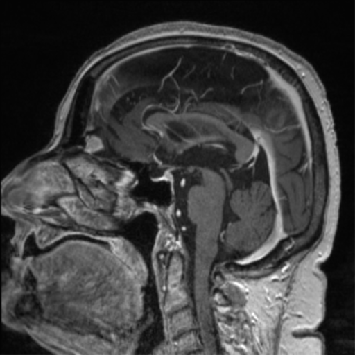File:Anaplastic astrocytoma IDH wild-type (pseudoprogression) (Radiopaedia 42209-45278 Axial T1 C+ 157).png