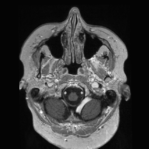 File:Anaplastic astrocytoma IDH wild-type (pseudoprogression) (Radiopaedia 42209-45278 Axial T1 C+ 26).png