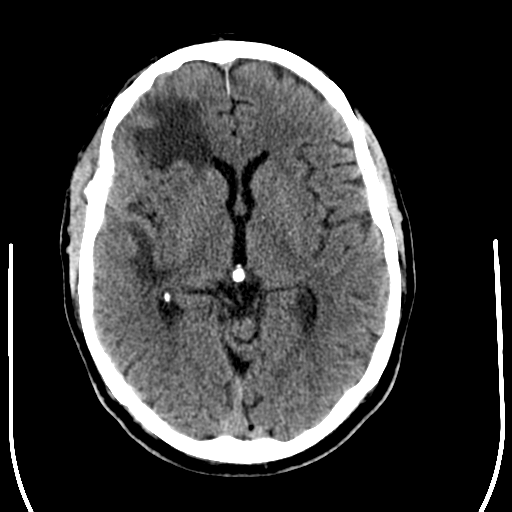 File:Anaplastic meningioma with recurrence (Radiopaedia 34452-35781 Axial non-contrast 16).png