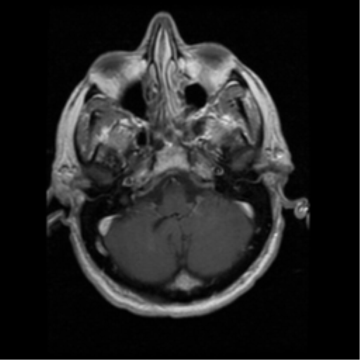 File:Anaplastic meningioma with recurrence (Radiopaedia 34452-35783 Axial T1 C+ 3).png
