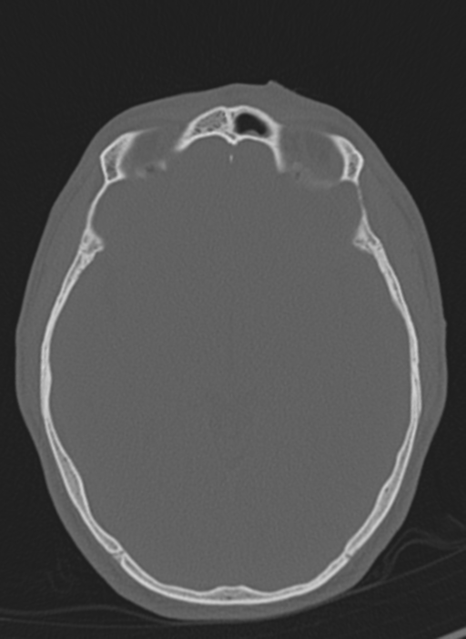 Anaplastic oligodendroglioma with skull fracture (Radiopaedia 74831-85846 Axial bone window 38).png