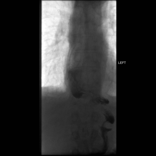 File:Anastomotic stricture post Ivor Lewis esophagectomy (Radiopaedia 47937-52715 C 20).png