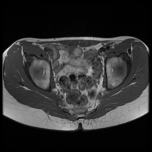 File:Androgen insensitivity syndrome (Radiopaedia 38585-40727 Axial T1 14).jpg
