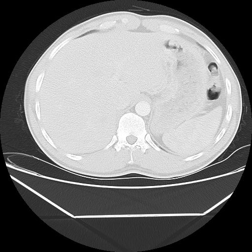 File:Aneurysmal bone cyst - rib (Radiopaedia 82167-96220 Axial lung window 58).jpg