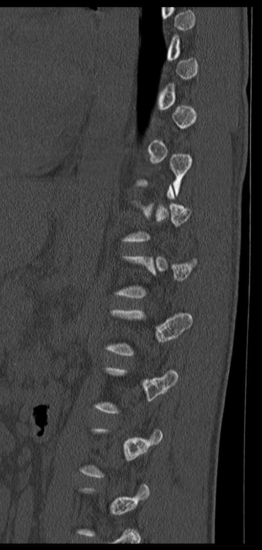 Aneurysmal bone cyst T11 (Radiopaedia 29294-29721 Sagittal bone window 25).jpg