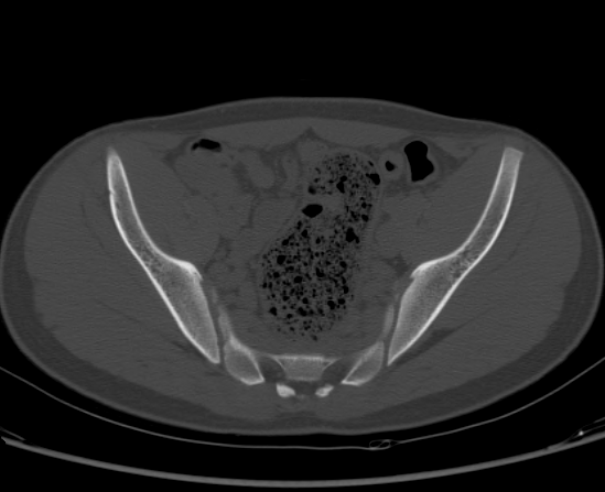 File:Aneurysmal bone cyst of ischium (Radiopaedia 25957-26094 Axial bone window 33).png