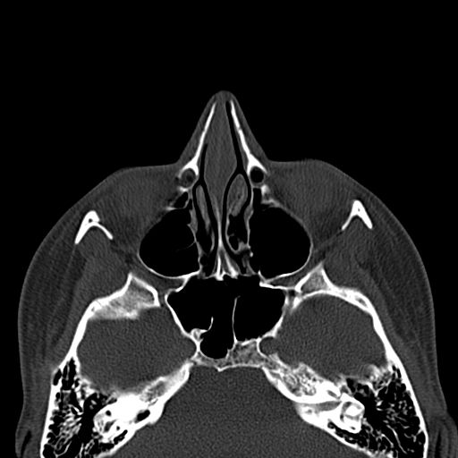 Aneurysmal bone cyst of the mandible (Radiopaedia 43280-46601 Axial bone window 86).jpg