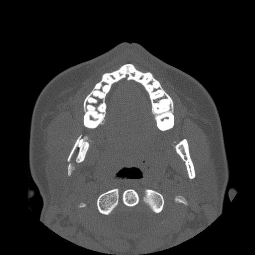 Aneurysmal bone cyst of the mandible (Radiopaedia 43280-46823 Axial bone window 84).jpg