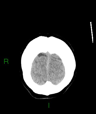 File:Aneurysmal subarachnoid hemorrhage with intra-axial extension (Radiopaedia 84371-99699 Coronal non-contrast 9).jpg