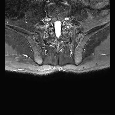 File:Ankylosing spondylitis with zygapophyseal arthritis (Radiopaedia 38433-40517 D 15).jpg