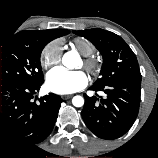 File:Anomalous left coronary artery from the pulmonary artery (ALCAPA) (Radiopaedia 70148-80181 A 133).jpg