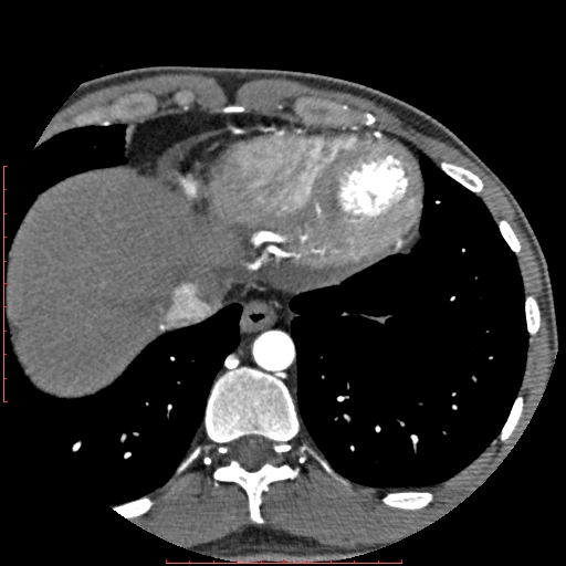 File:Anomalous left coronary artery from the pulmonary artery (ALCAPA) (Radiopaedia 70148-80181 A 340).jpg