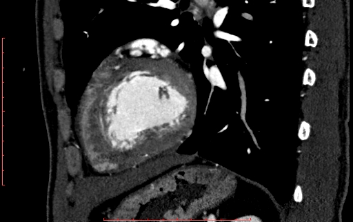 File:Anomalous left coronary artery from the pulmonary artery (ALCAPA) (Radiopaedia 70148-80181 C 188).jpg