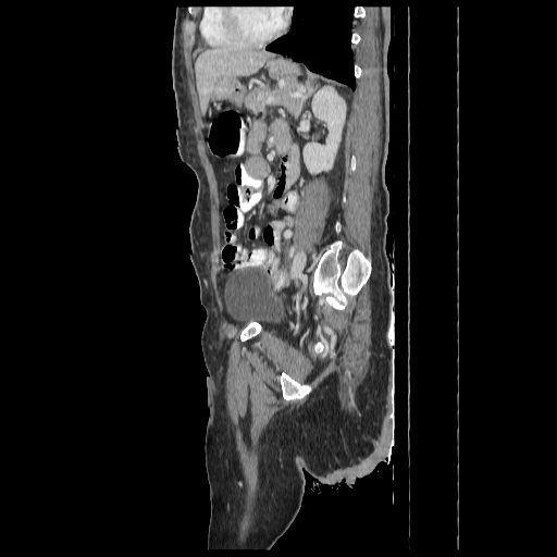 Anorectal carcinoma (Radiopaedia 44413-48064 C 70).jpg