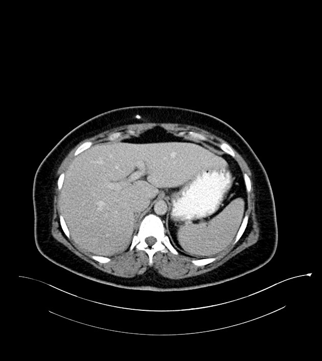 Anterior abdominal wall CSF pseudocyst (CSFoma) (Radiopaedia 79453-92571 A 23).jpg