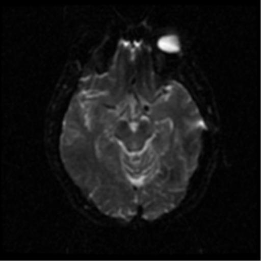 File:Anterior cerebral artery territory infarct (Radiopaedia 39327-41584 Axial DWI 35).png
