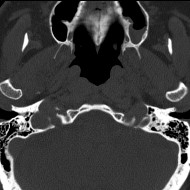 Anterior cervical postdiscectomy arthrodesis (Radiopaedia 32678-33646 Axial bone window 3).jpg
