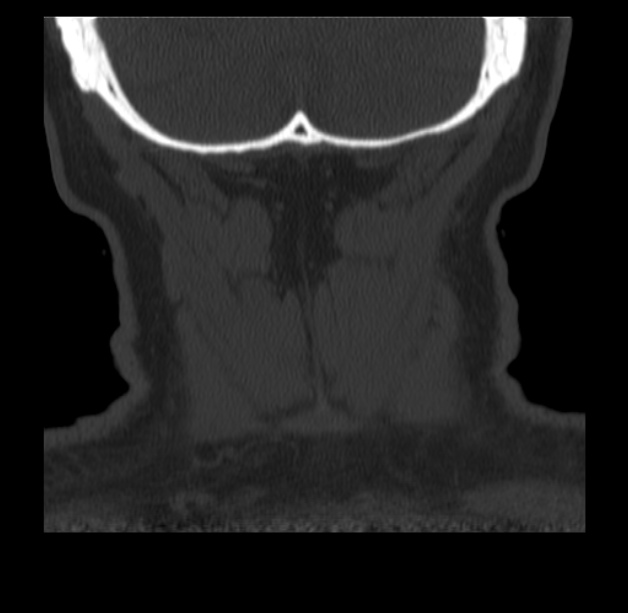 Anterior cervical postdiscectomy arthrodesis (Radiopaedia 32678-33646 Coronal bone window 74).jpg