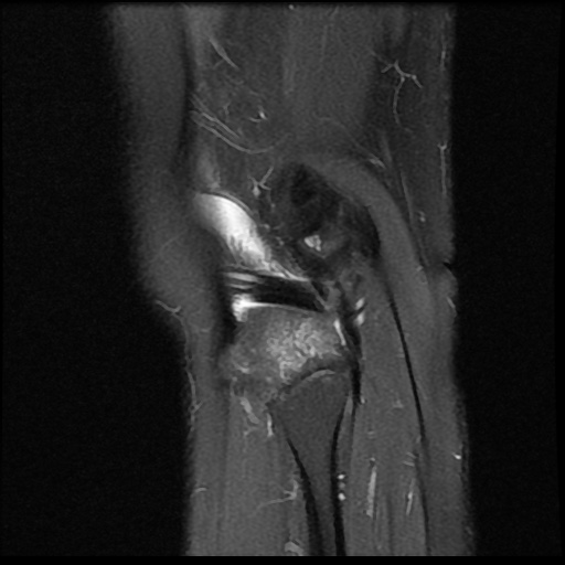 File:Anterior cruciate ligament avulsion fracture (Radiopaedia 58939-66193 Sagittal PD fat sat 4).jpg