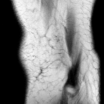 Anterior cruciate ligament mucoid degeneration (Radiopaedia 60853-68633 Sagittal T1 55).jpg