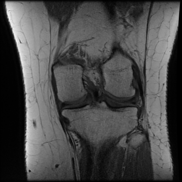 File:Anterior cruciate ligament tear, Wrisberg rip and bucket-handle tear of medial meniscus (Radiopaedia 75872-87266 Coronal T1 18).jpg
