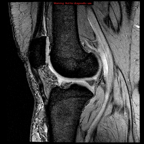 File:Anterior cruciate ligament tear (Radiopaedia 12329-12612 A 9).jpg