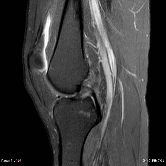 File:Anterior cruciate ligament tear (Radiopaedia 70783-80964 Sagittal PD fat sat 7).jpg