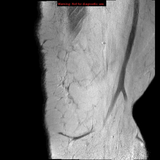 File:Anterior cruciate ligament tear - complete (Radiopaedia 12175-12514 Sagittal PD 22).jpg