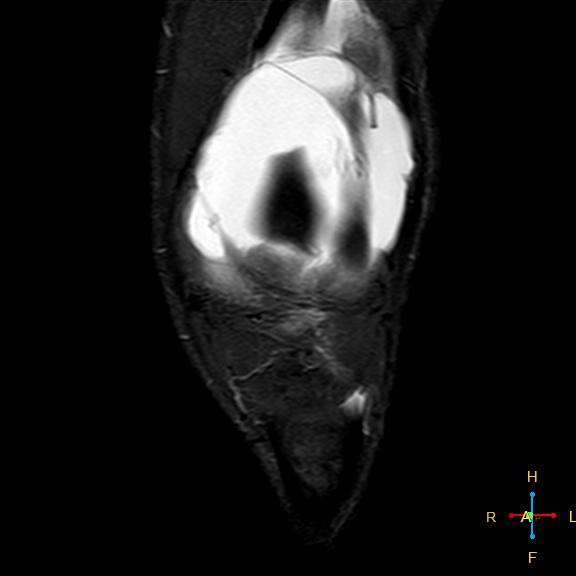 File:Anterior cruciate ligament tear - complete (Radiopaedia 24907-25170 Coronal STIR 4).jpg