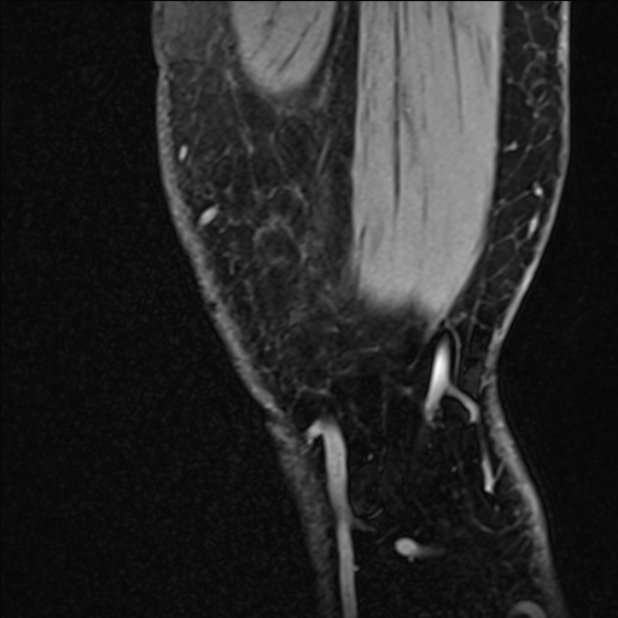 Anterior cruciate ligament tear - ramp lesion (Radiopaedia 71883-82322 Sagittal T1 vibe 137).jpg