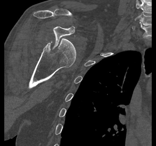 Anterior glenohumeral dislocation with Hill-Sachs lesion (Radiopaedia 62877-71249 Coronal bone window 42).jpg