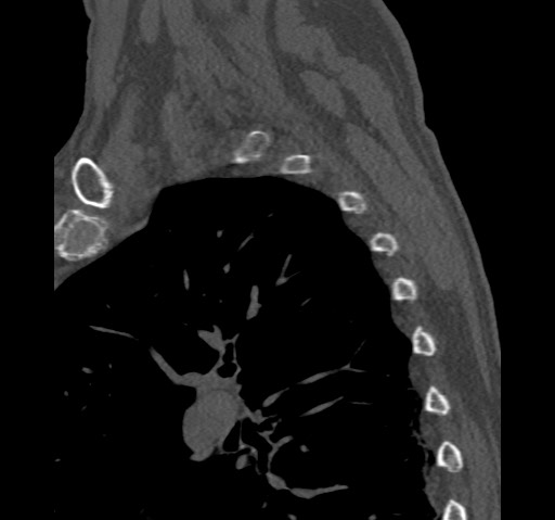 File:Anterior glenohumeral dislocation with Hill-Sachs lesion (Radiopaedia 62877-71249 Sagittal bone window 69).jpg