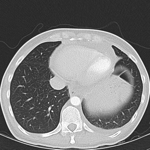 Anterior mediastinal lymphoma (Radiopaedia 29556-30061 Axial lung window 44).jpg