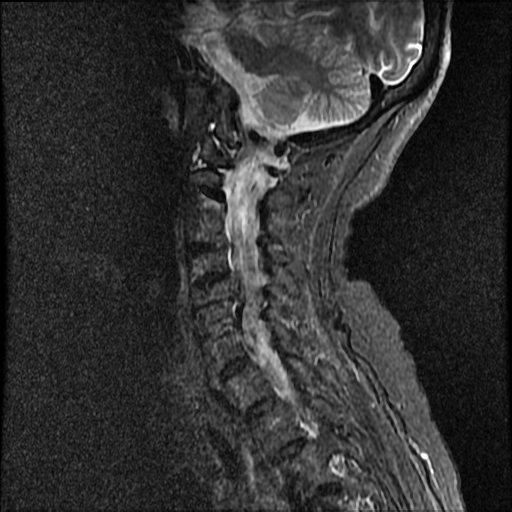 File:Anterior spinal artery syndrome (Radiopaedia 46335-50750 Sagittal STIR 8).png