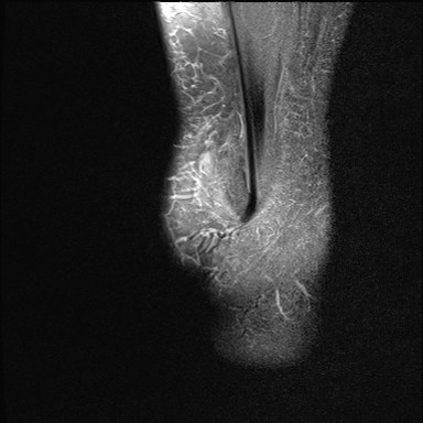 File:Anterior talofibular ligament injury - rupture with soft-tissue impingement (Radiopaedia 38765-40928 Sagittal PD fat sat 21).jpg