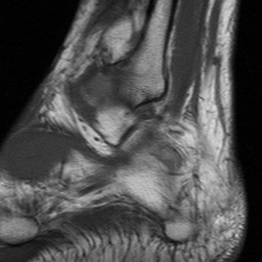 File:Anterior talofibular ligament rupture (Radiopaedia 15831-15484 Sagittal T1 5).jpg