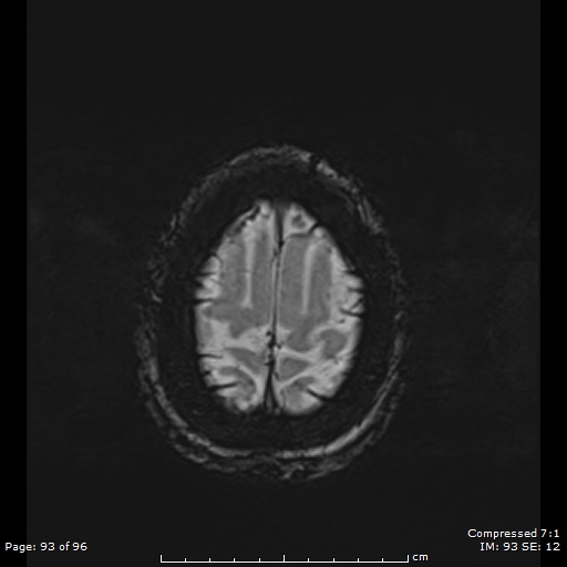 Anterior temporal lobe perivascular space (Radiopaedia 88283-104914 Axial SWI 62).jpg