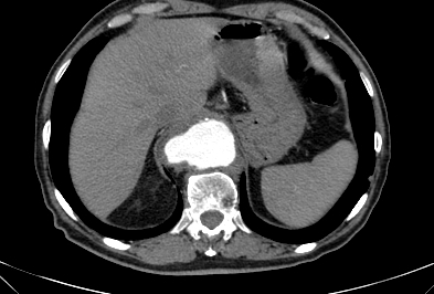 File:Anterior vertebral scalloping (abdominal aortic aneurysm) (Radiopaedia 66744-76067 F 3).jpg