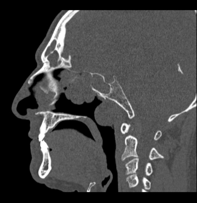 Antrochoanal polyp (Radiopaedia 79011-92169 Sagittal bone window 34).jpg