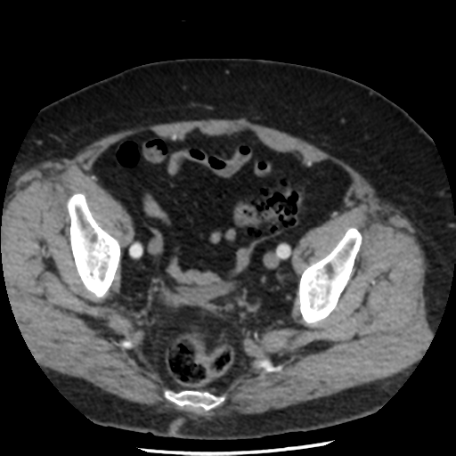 File:Aortic aneurysm and dissection - Stanford type A (Radiopaedia 36693-38261 A 90).png