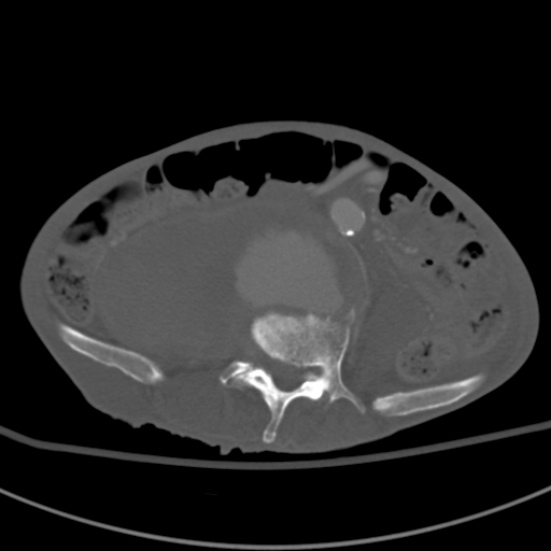 Aortic aneurysm with spinal destruction (Radiopaedia 42301-45410 Axial bone window 64).jpg