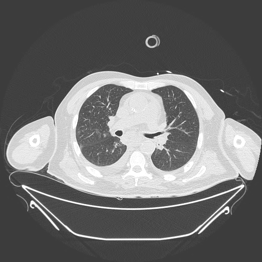 Aortic arch aneurysm (Radiopaedia 84109-99365 Axial lung window 133).jpg