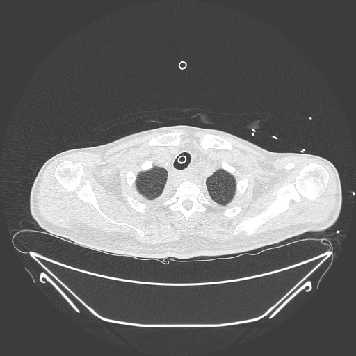 Aortic arch aneurysm (Radiopaedia 84109-99365 Axial lung window 49).jpg